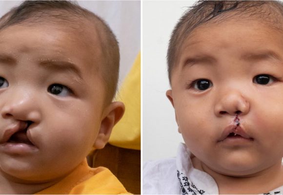 A New Smile for Phone Myat Zaw – Sagaing, Myanmar A New Smile for Phone Myat Zaw – Sagaing, Myanmar